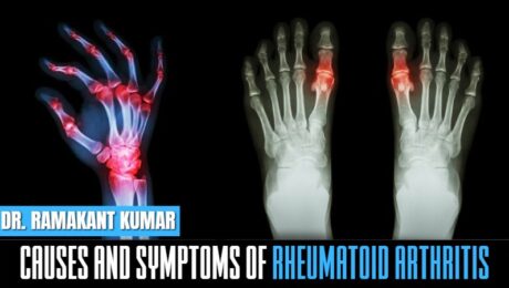 Causes and Symptoms of Rheumatoid Arthritis