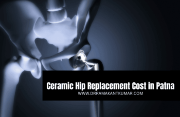 Ceramic Hip Replacement Cost in Patna