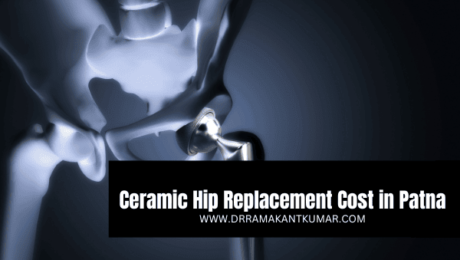Ceramic Hip Replacement Cost in Patna