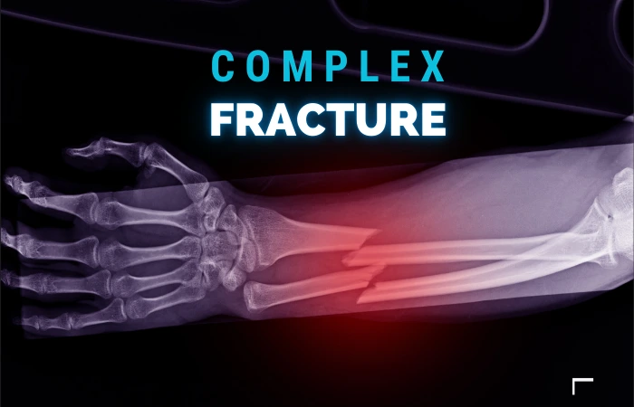 Complex Fracture Treatment in Patna