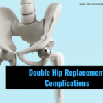 double hip replacement complications