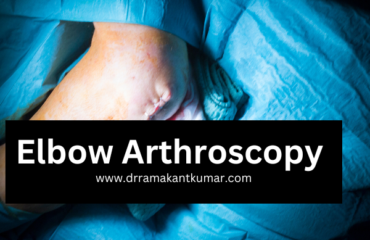 Tips for Elbow Arthroscopy Surgery