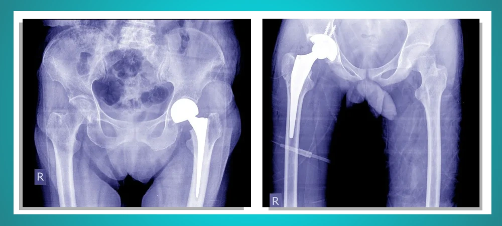 Hip replacement image