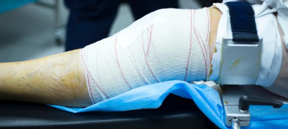 Knee Arthroscopy Surgery in Patna