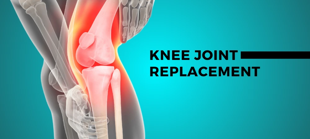 Knee Joint Replacement in Patna