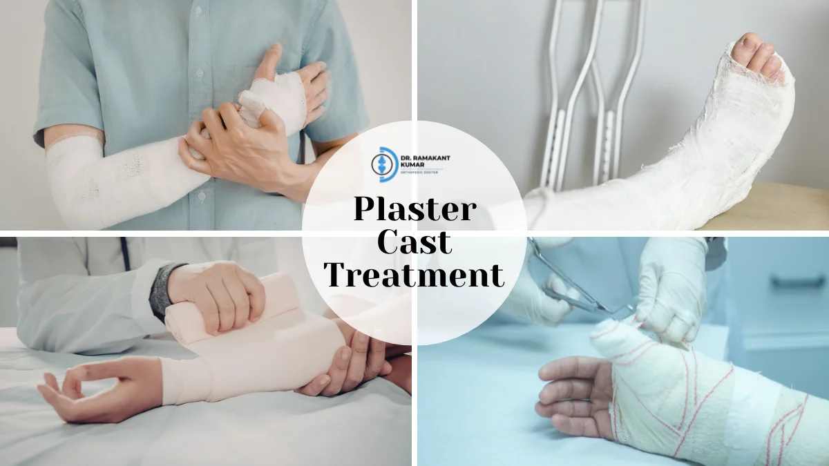 Plaster Cast Treatment for Bone Fractures in Patna