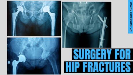 Surgery for Hip Fractures
