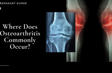 Where Does Osteoarthritis Commonly Occur