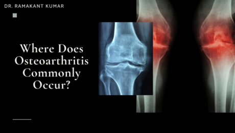 Where Does Osteoarthritis Commonly Occur