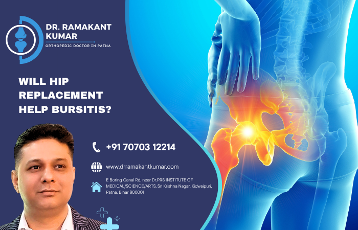 Will Hip Replacement Help Bursitis