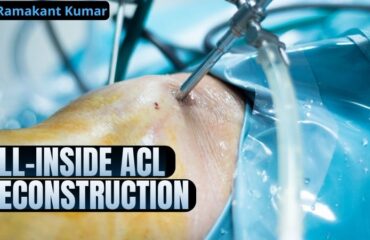 All-inside ACL reconstruction is a newly developed advanced surgical procedure for treating ACL injuries.