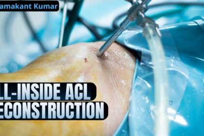 All-inside ACL reconstruction is a newly developed advanced surgical procedure for treating ACL injuries.