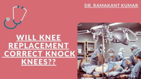will knee replacement correct knock knees